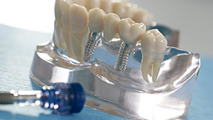 Implantate als
