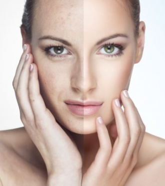 Microneedling