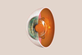 ICL-Implantation – die Alternative zum Augenlasern